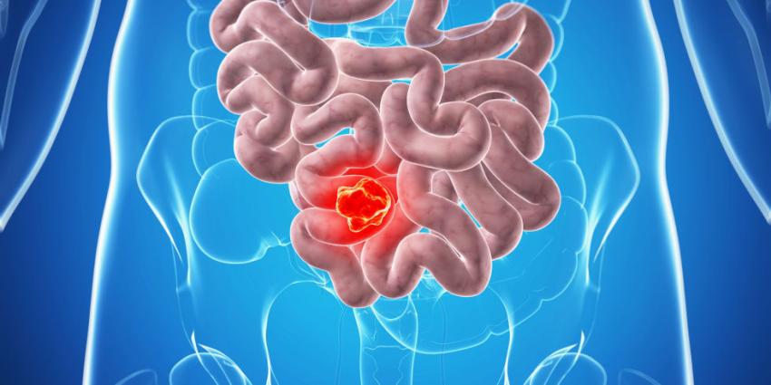 Darmkrebs: Vorsorge und Früherkennung mit neuer ...
